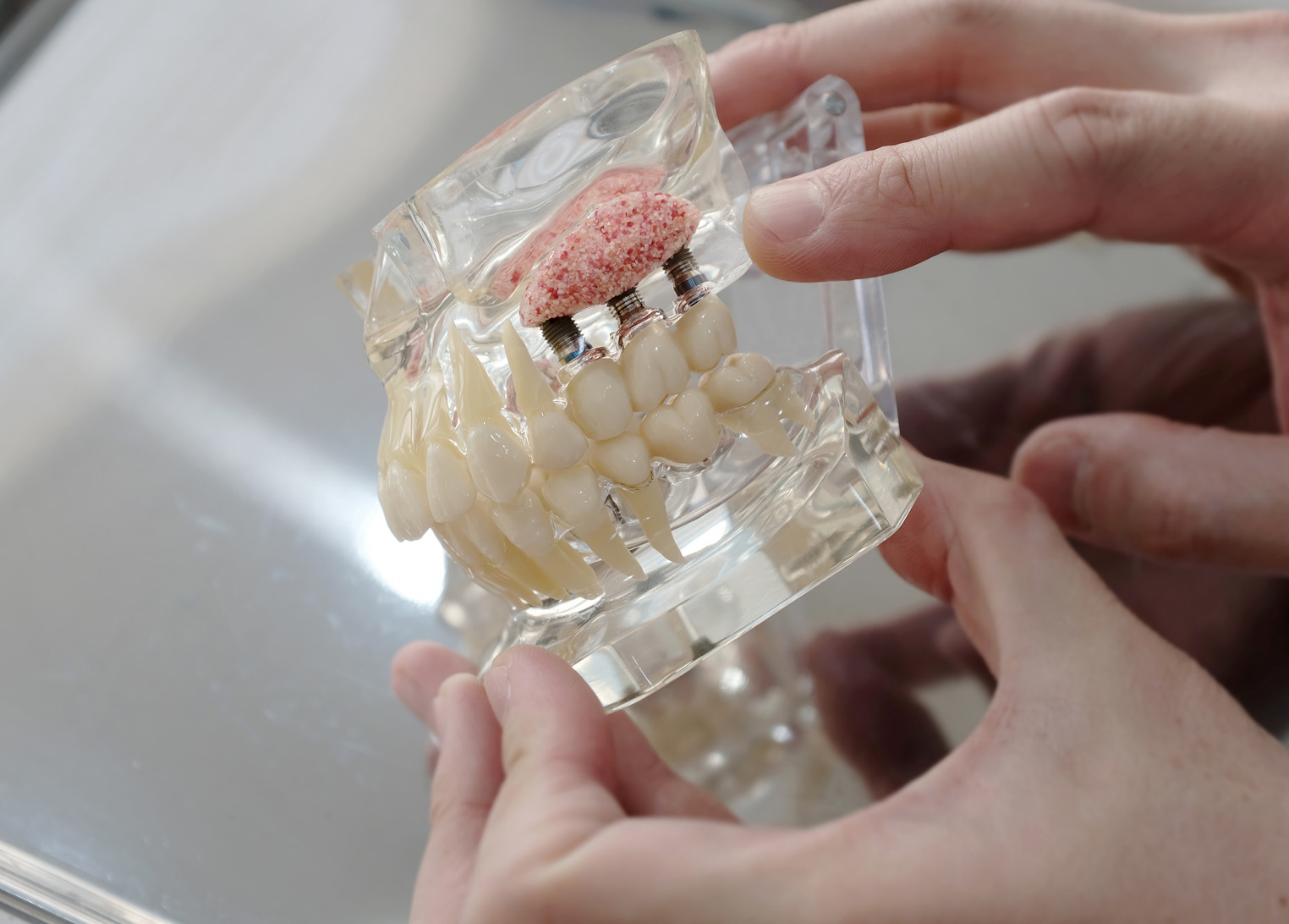 Bone grafting for restoring jawbone support