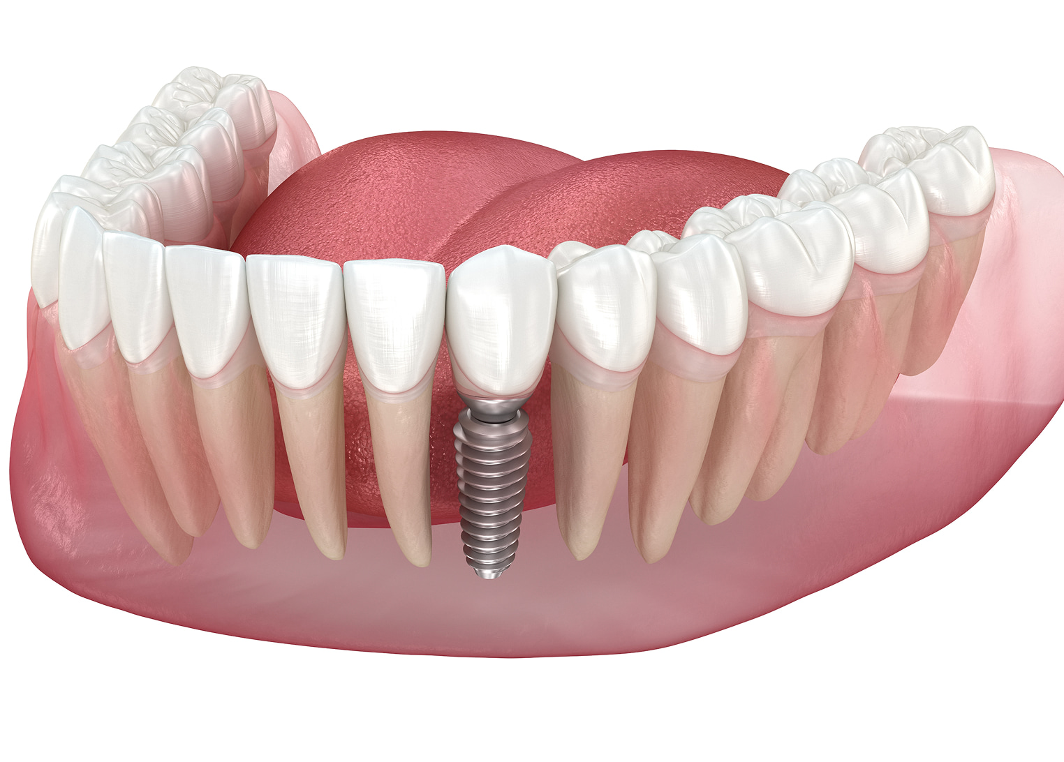 Dental implants replace missing teeth with a titanium or ceramic post and natural-looking crown