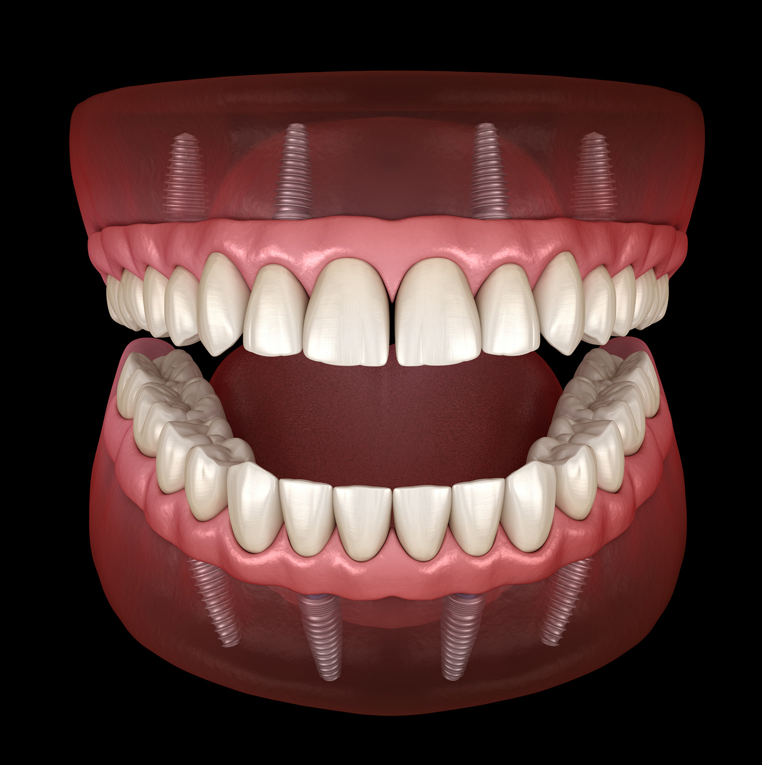All-on-4® Dental Implants