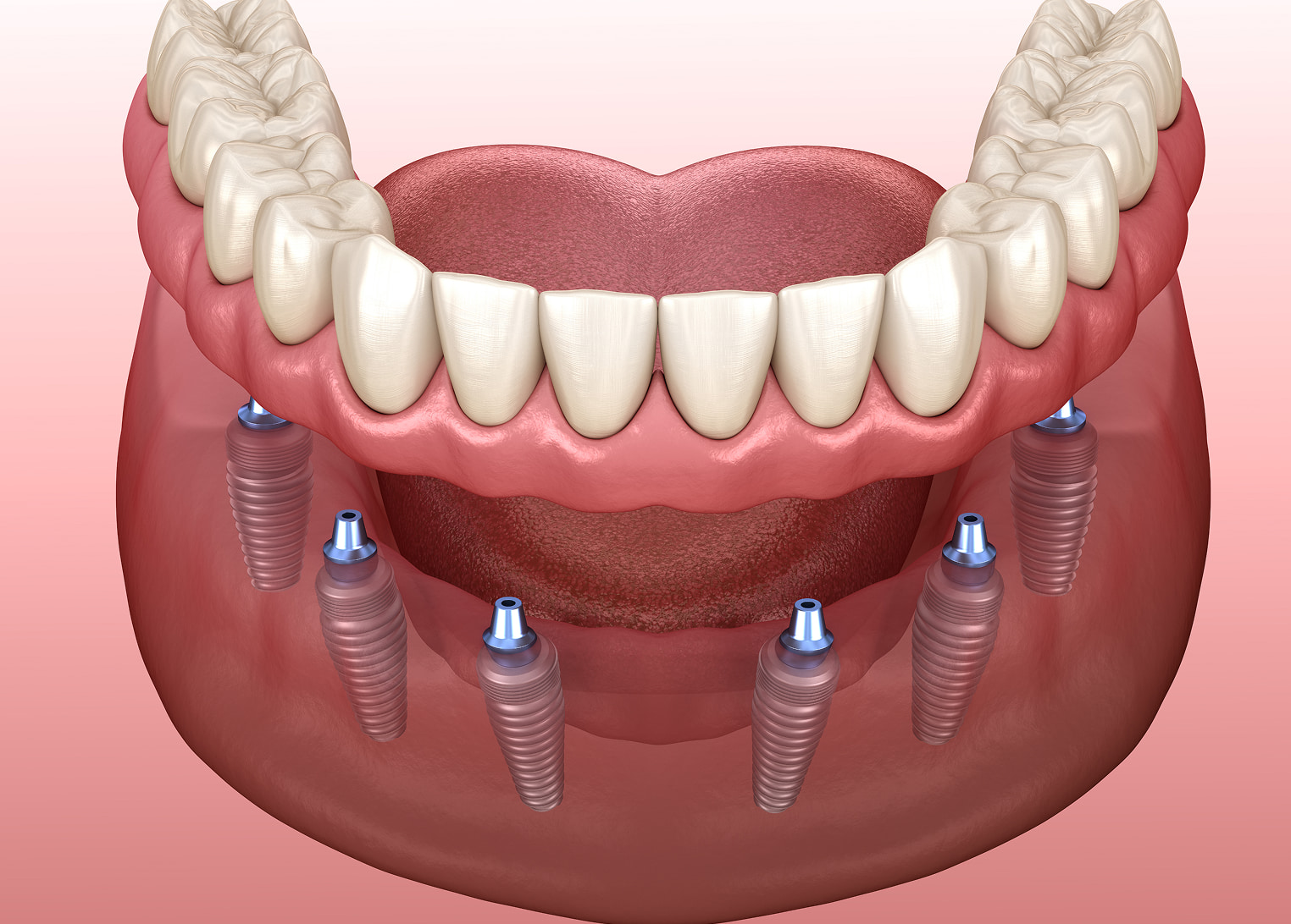 All-on-6 Implant System