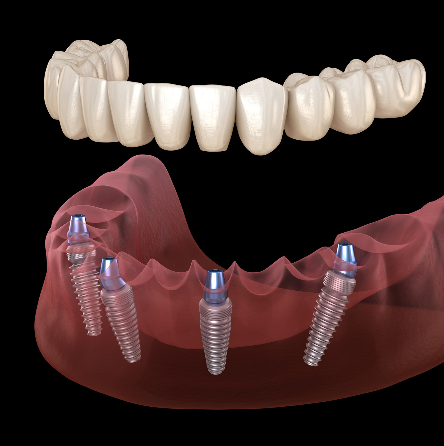 Custom Full Arch Implant Bridges