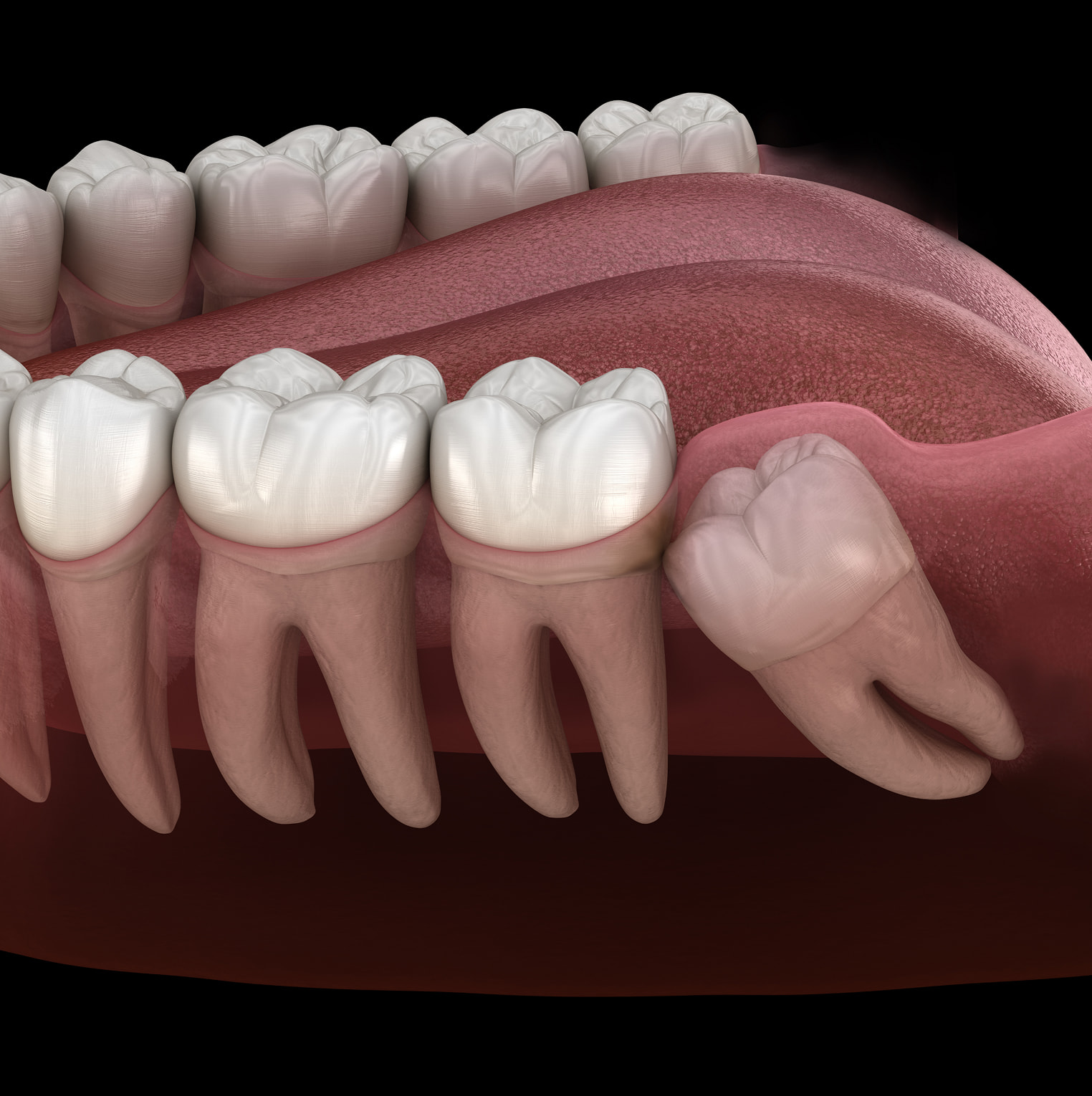 Symptoms that indicate wisdom teeth may need removal