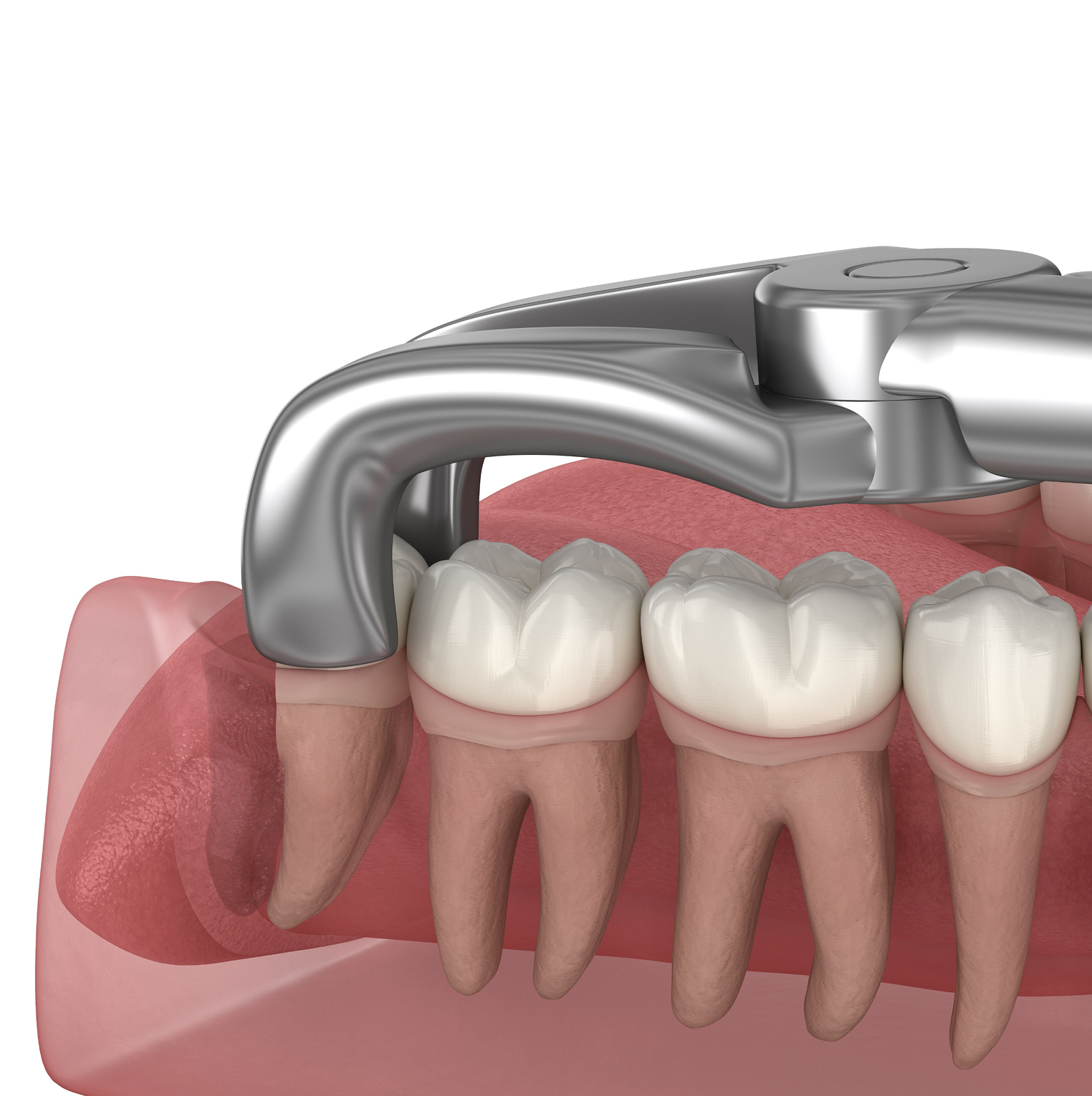 Sedation options available for comfortable wisdom tooth removal