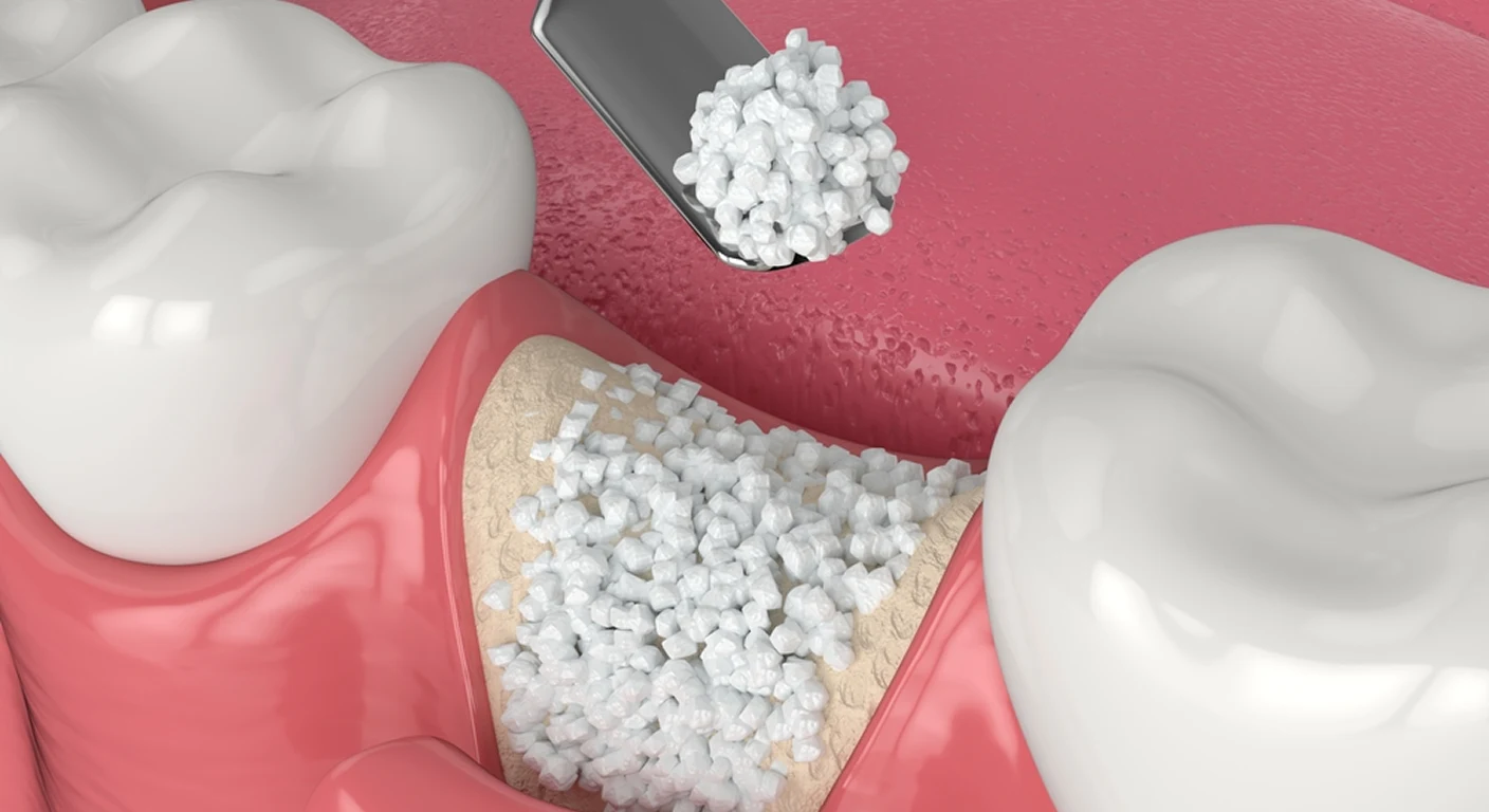 Understanding Bone Grafting
